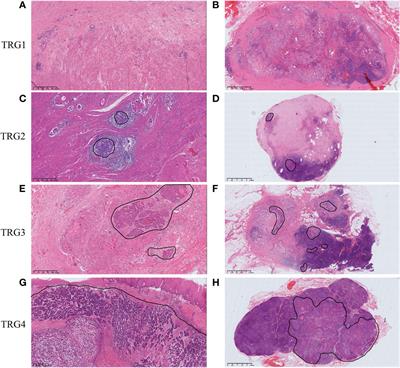 Distribution of residual tumors in esophageal squamous cell carcinoma after neoadjuvant PD-1 blockade combined with chemotherapy